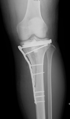 脛骨高原骨折に対するプレート固定 手術後